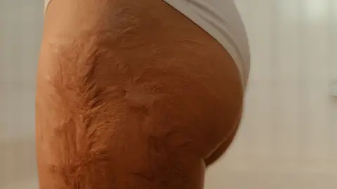 Cellulite sur les cuisses : causes fréquentes et gestes utiles